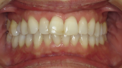 1 Frontal in occlusion 